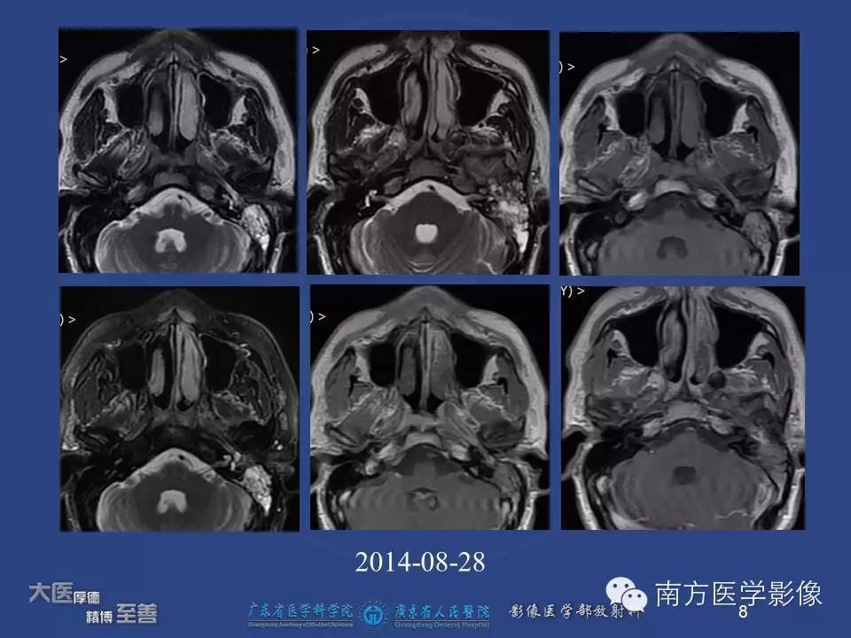 【PPT】鼻咽癌累及中耳及与中耳炎的鉴别-8