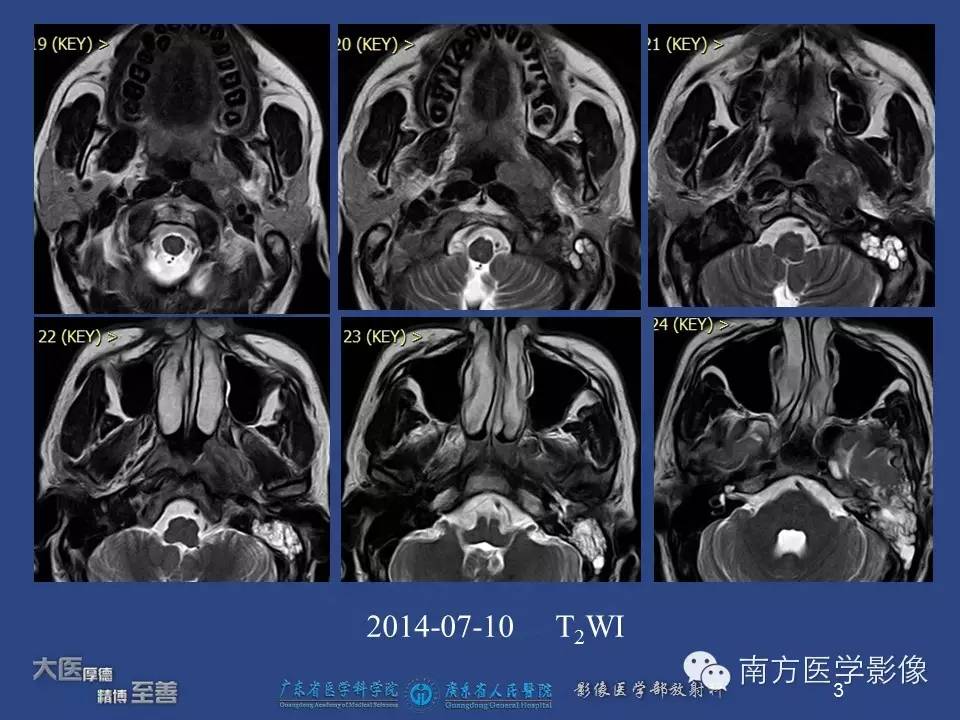 【PPT】鼻咽癌累及中耳及与中耳炎的鉴别-3