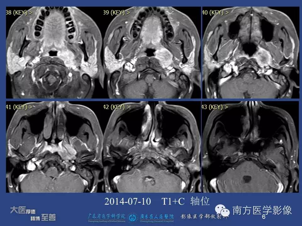 【PPT】鼻咽癌累及中耳及与中耳炎的鉴别-6