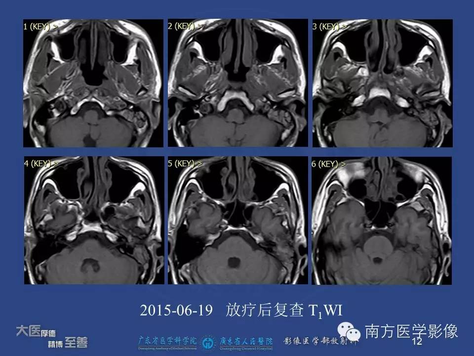 【PPT】鼻咽癌累及中耳及与中耳炎的鉴别-12