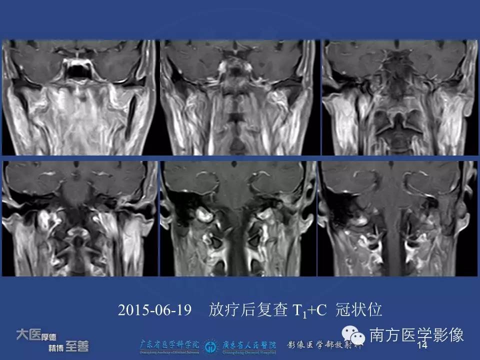 【PPT】鼻咽癌累及中耳及与中耳炎的鉴别-14