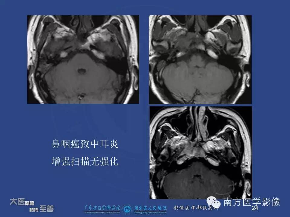 【PPT】鼻咽癌累及中耳及与中耳炎的鉴别-24