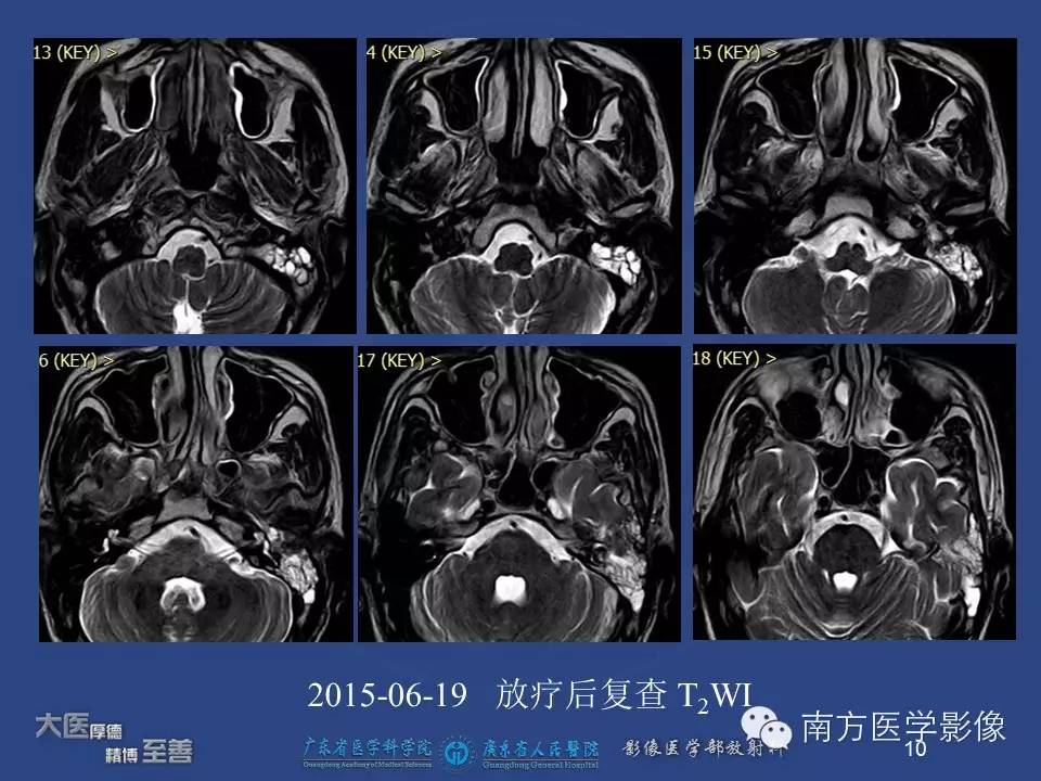 【PPT】鼻咽癌累及中耳及与中耳炎的鉴别-10