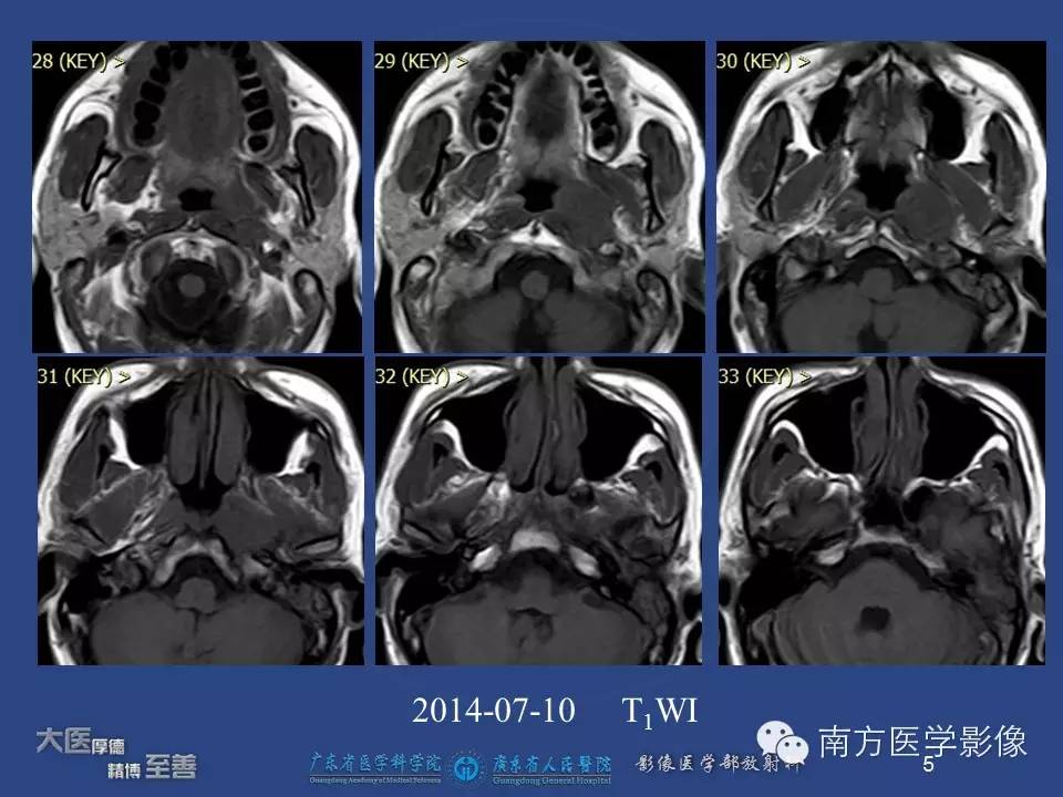 【PPT】鼻咽癌累及中耳及与中耳炎的鉴别-5