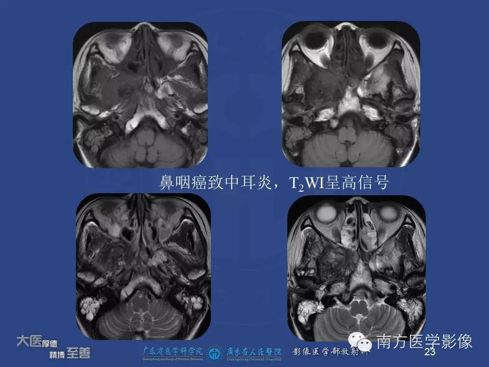 【PPT】鼻咽癌累及中耳及与中耳炎的鉴别-23