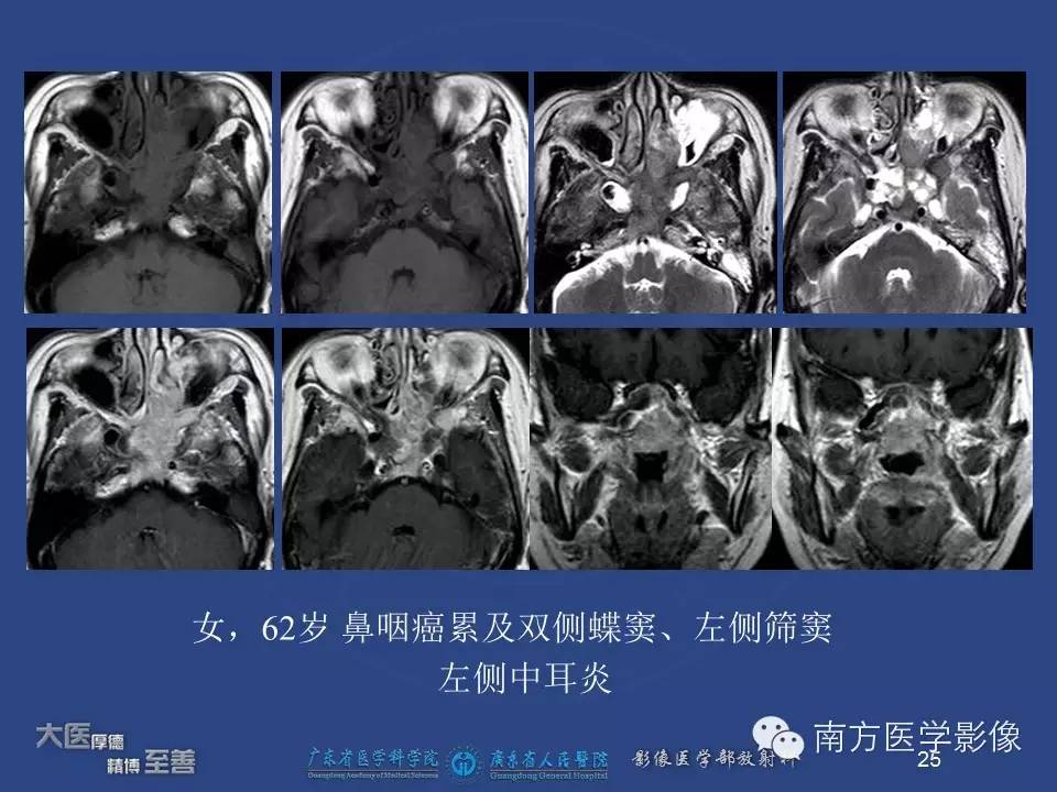 【PPT】鼻咽癌累及中耳及与中耳炎的鉴别-25