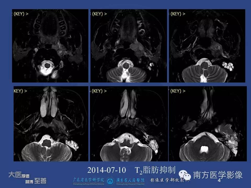 【PPT】鼻咽癌累及中耳及与中耳炎的鉴别-4