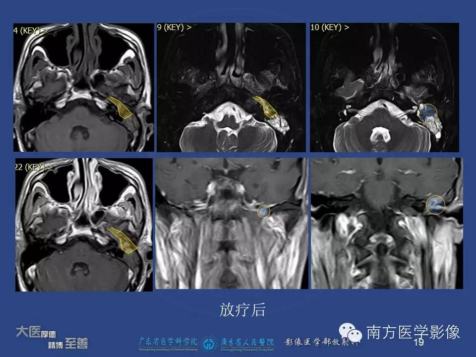 【PPT】鼻咽癌累及中耳及与中耳炎的鉴别-19