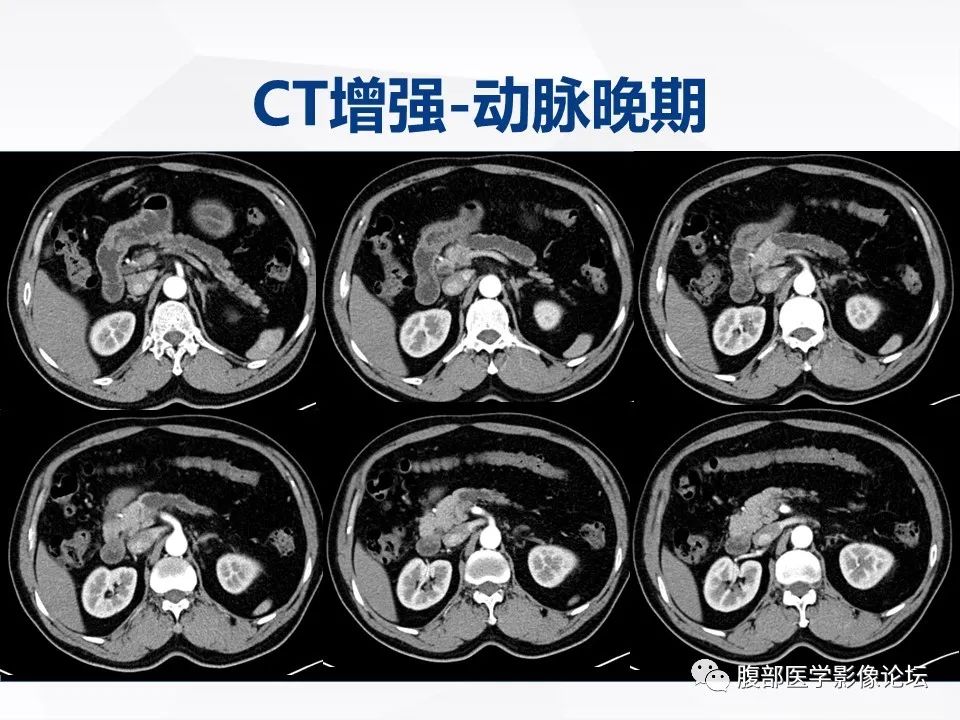 【病例】胰腺导管内神经内分泌肿瘤1例CT及MR-4