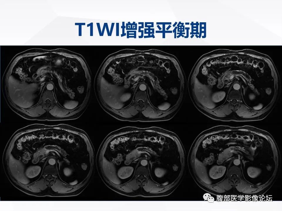 【病例】胰腺导管内神经内分泌肿瘤1例CT及MR-12