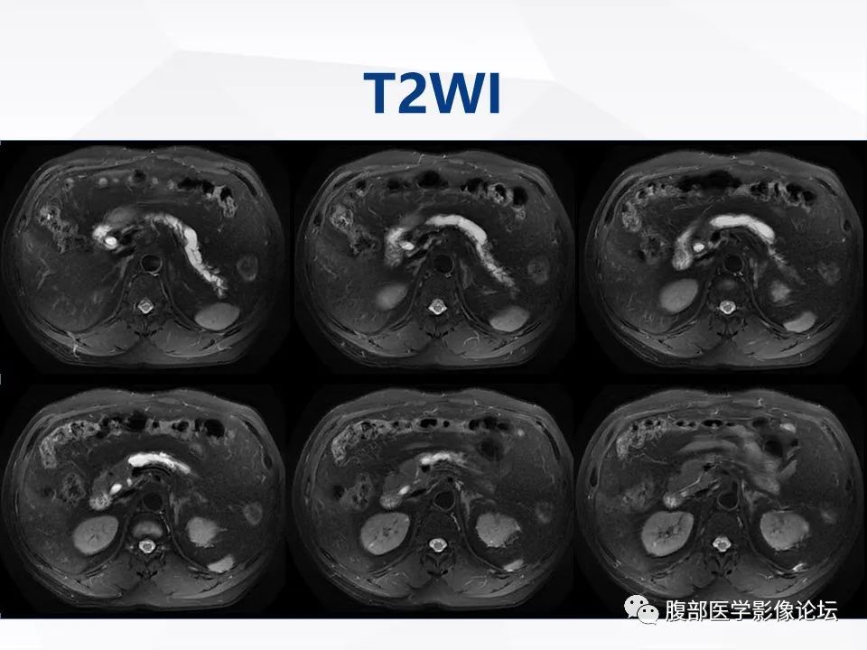【病例】胰腺导管内神经内分泌肿瘤1例CT及MR-8