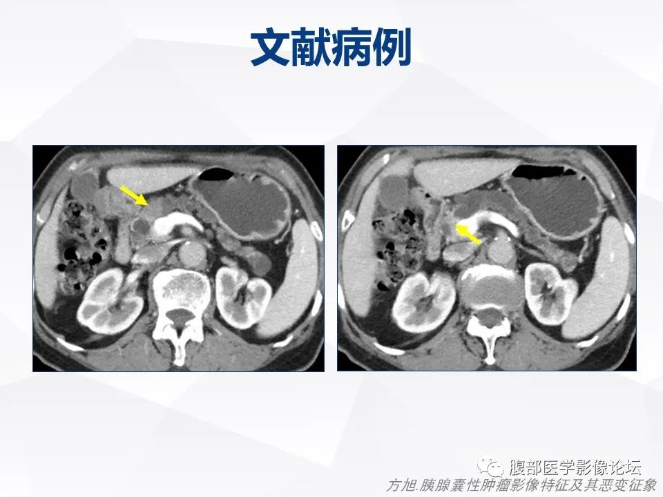【病例】胰腺导管内神经内分泌肿瘤1例CT及MR-26