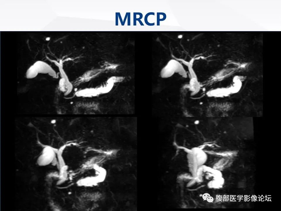 【病例】胰腺导管内神经内分泌肿瘤1例CT及MR-16