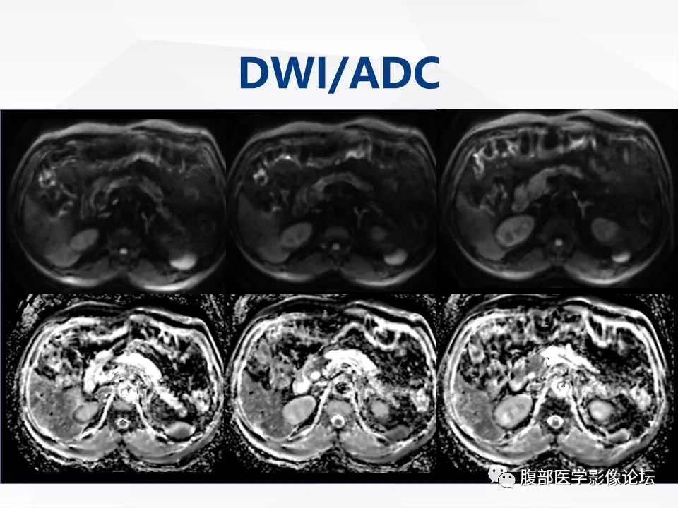 【病例】胰腺导管内神经内分泌肿瘤1例CT及MR-15