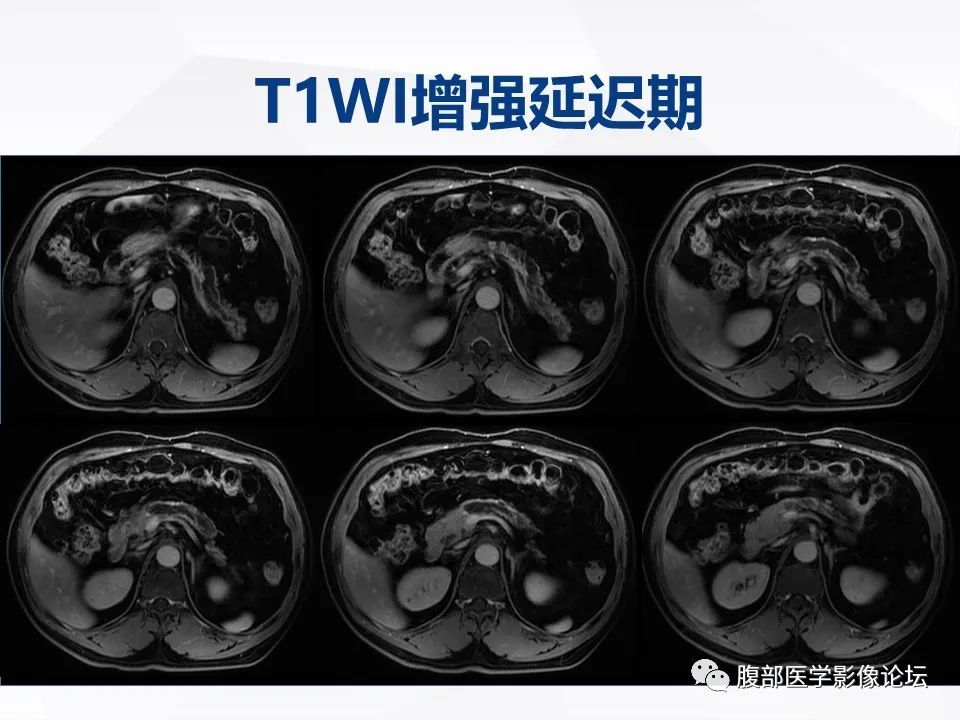 【病例】胰腺导管内神经内分泌肿瘤1例CT及MR-13