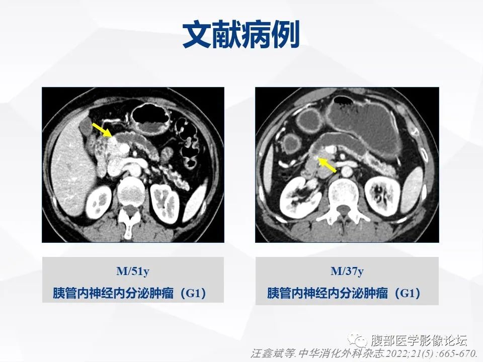 【病例】胰腺导管内神经内分泌肿瘤1例CT及MR-24