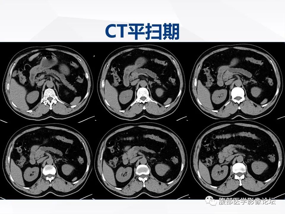 【病例】胰腺导管内神经内分泌肿瘤1例CT及MR-3