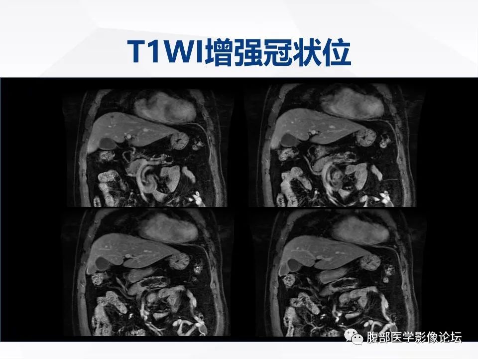 【病例】胰腺导管内神经内分泌肿瘤1例CT及MR-14