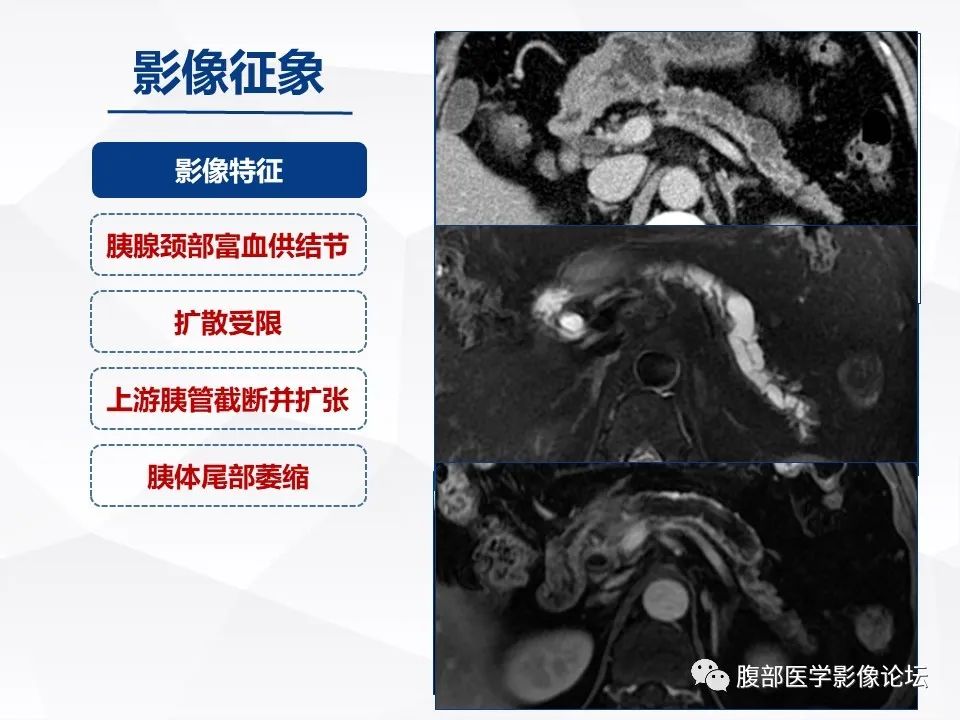 【病例】胰腺导管内神经内分泌肿瘤1例CT及MR-21
