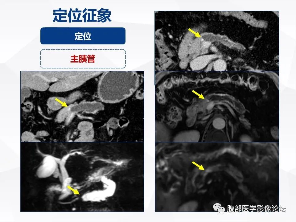 【病例】胰腺导管内神经内分泌肿瘤1例CT及MR-20