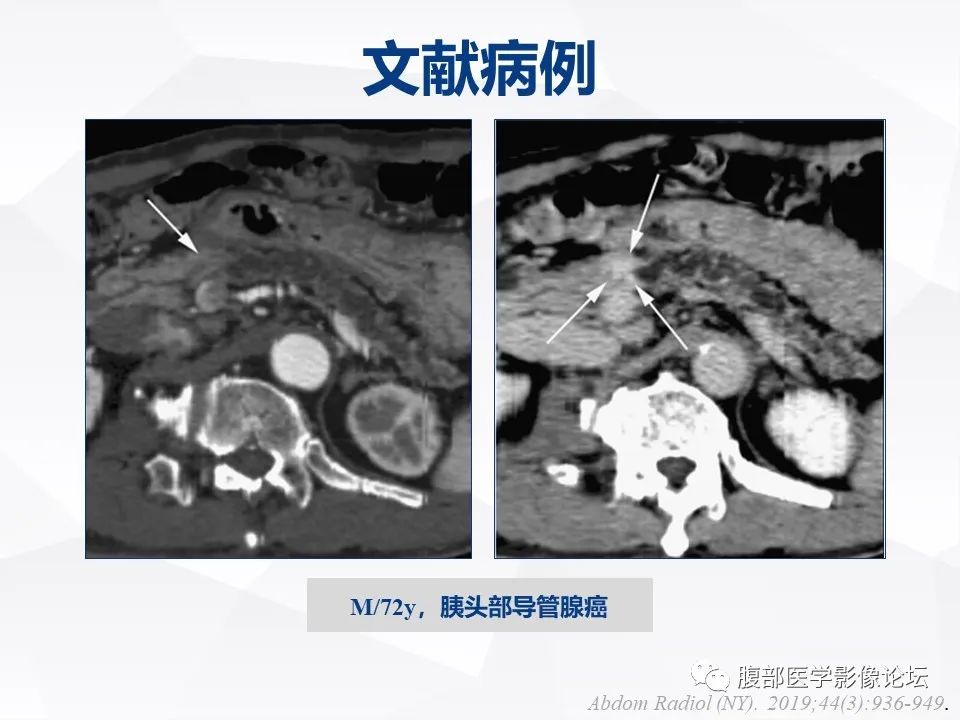 【病例】胰腺导管内神经内分泌肿瘤1例CT及MR-30