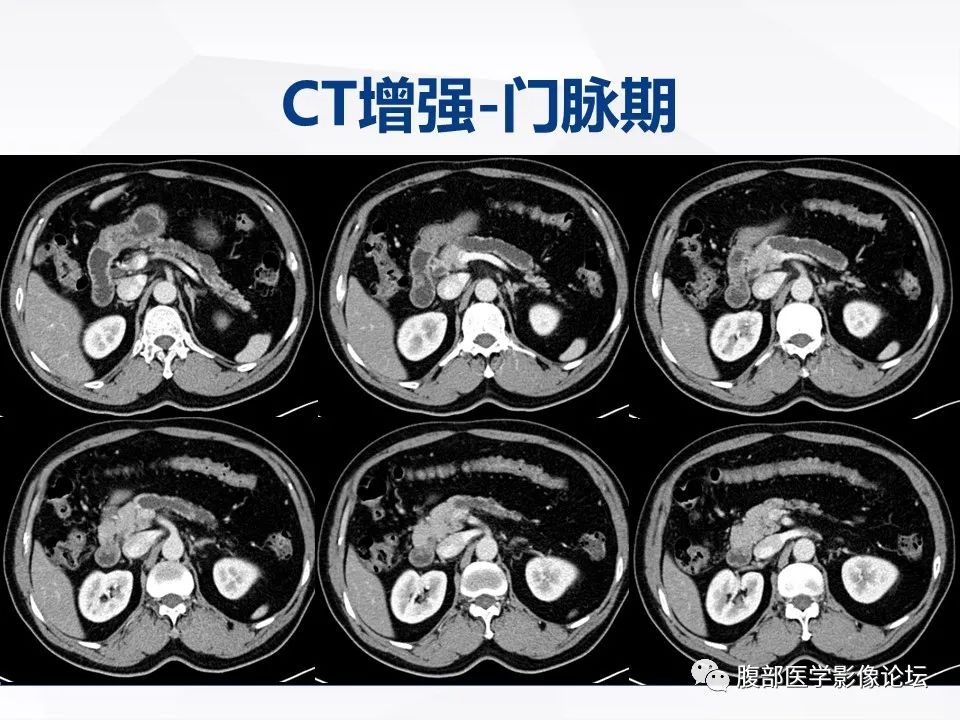 【病例】胰腺导管内神经内分泌肿瘤1例CT及MR-5