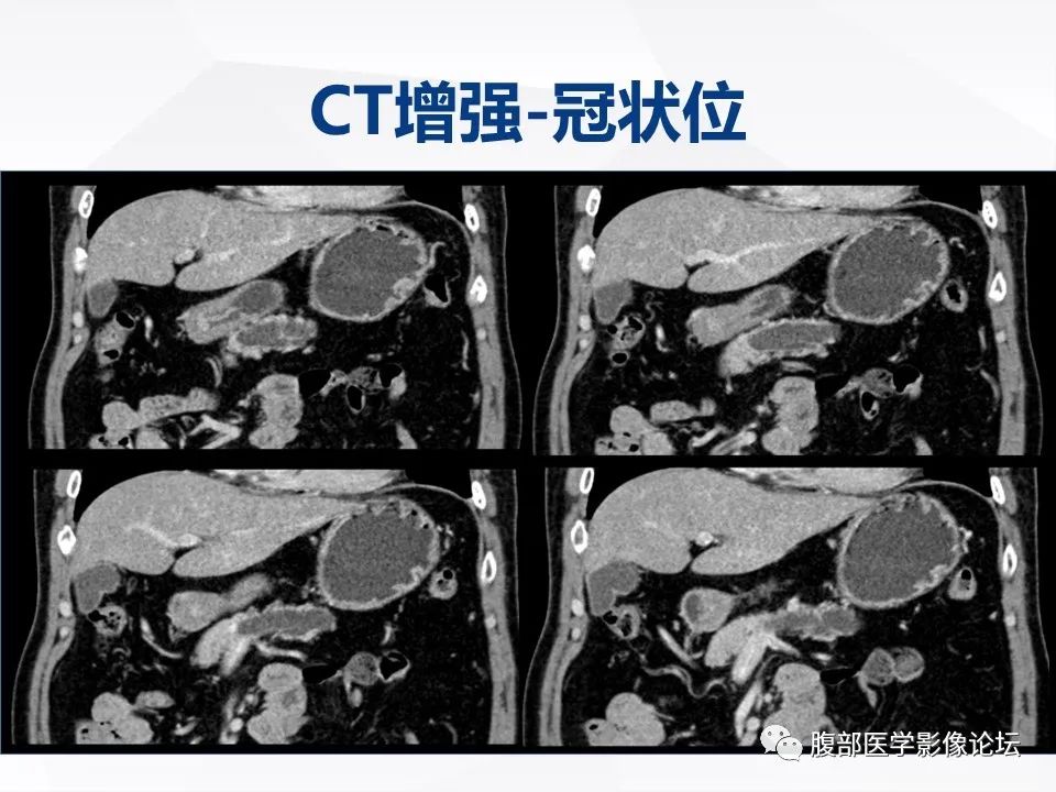 【病例】胰腺导管内神经内分泌肿瘤1例CT及MR-7