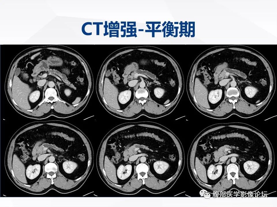 【病例】胰腺导管内神经内分泌肿瘤1例CT及MR-6