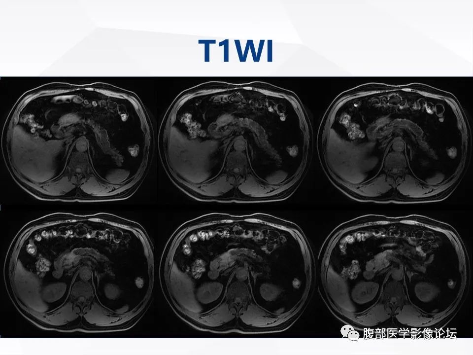【病例】胰腺导管内神经内分泌肿瘤1例CT及MR-9