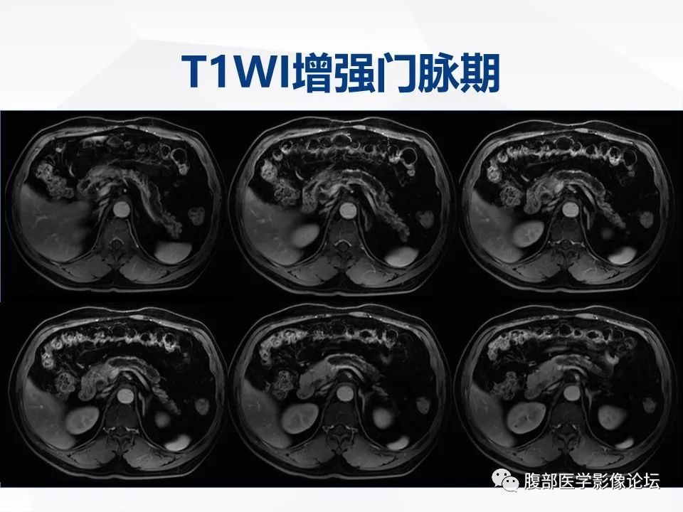 【病例】胰腺导管内神经内分泌肿瘤1例CT及MR-11