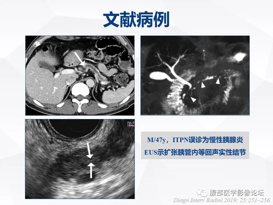 【病例】胰腺导管内神经内分泌肿瘤1例CT及MR-28
