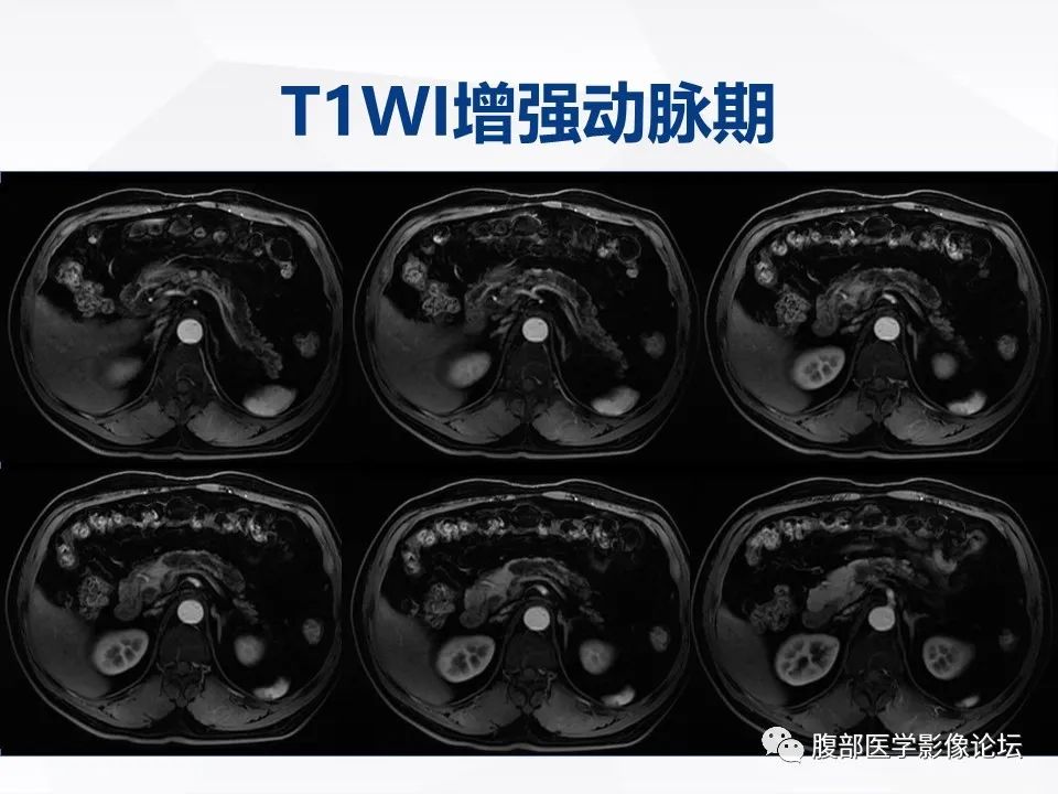 【病例】胰腺导管内神经内分泌肿瘤1例CT及MR-10