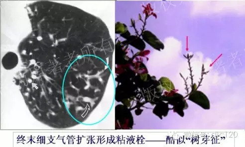 胸部CT基本征象-树芽征