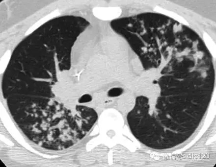 胸部CT基本征象--树芽征--图文讲解