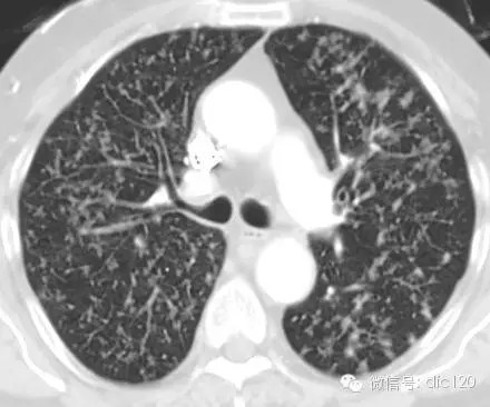 胸部CT基本征象--树芽征--图文讲解