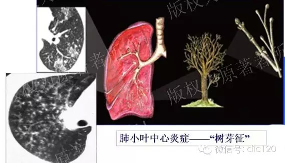 胸部CT基本征象--树芽征--图文讲解