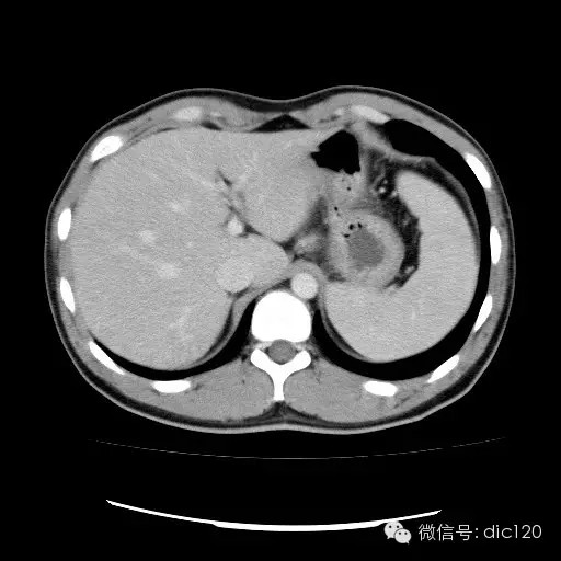 肝实质一过性强化CT影像表现