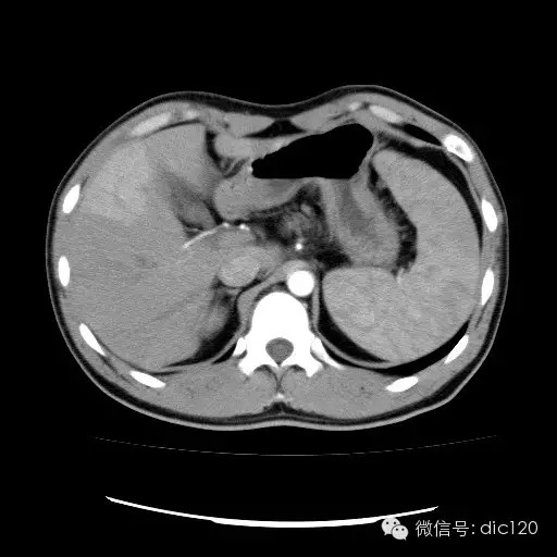 肝实质一过性强化CT影像表现