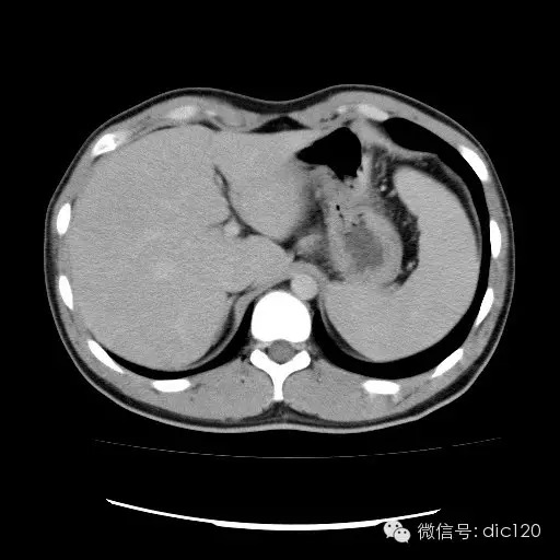 肝实质一过性强化CT影像表现
