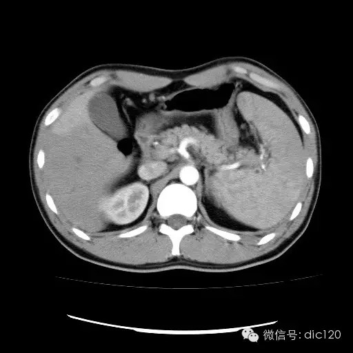 肝实质一过性强化CT影像表现