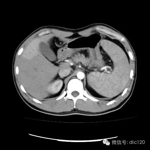 肝实质一过性强化CT影像表现