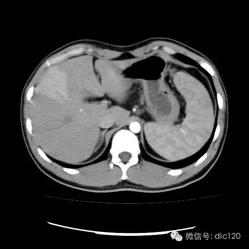肝实质一过性强化CT影像表现