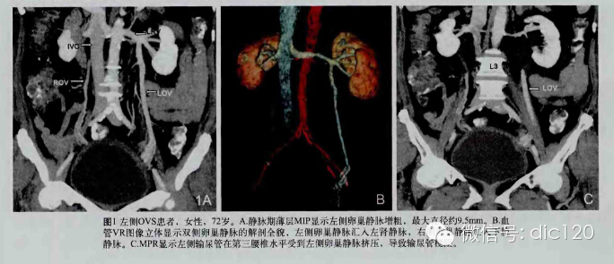 【病例】卵巢静脉综合征病例及资料分享