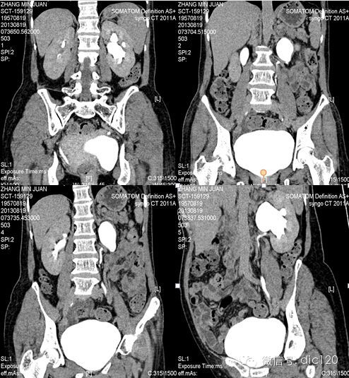 【病例】卵巢静脉综合征病例及资料分享