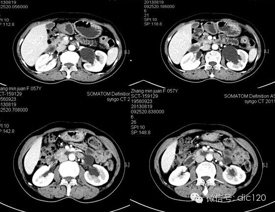 【病例】卵巢静脉综合征病例及资料分享