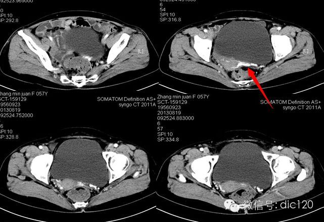 【病例】卵巢静脉综合征病例及资料分享
