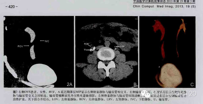 【病例】卵巢静脉综合征病例及资料分享