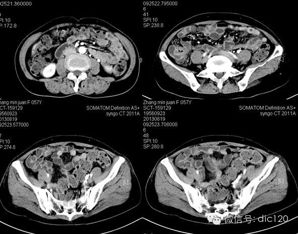【病例】卵巢静脉综合征病例及资料分享