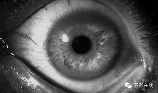 【CT病例】肝脏病变——肝豆状核变性 【CT病例】肝脏病变——肝豆状核变性