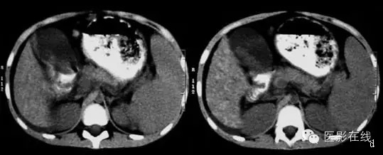 【CT病例】肝脏病变——肝豆状核变性 【CT病例】肝脏病变——肝豆状核变性
